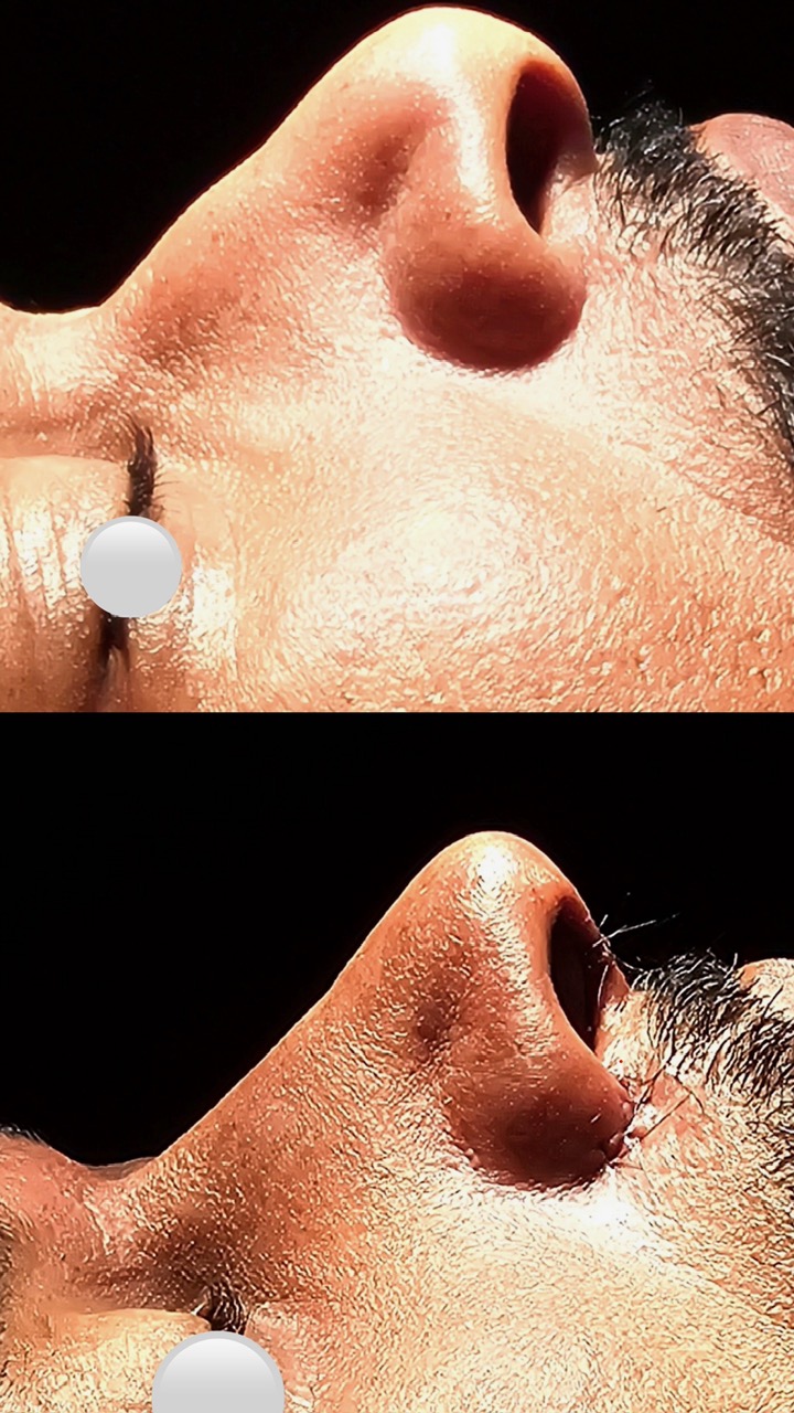 Caso Clínico 05 - Rinoplastia Masculina